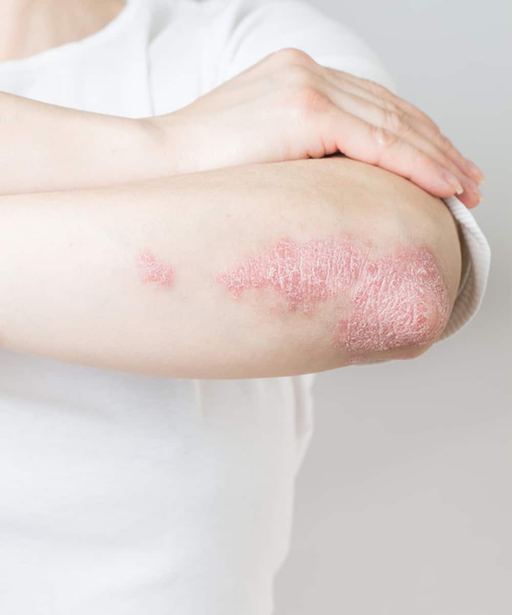 Understanding Psoriasis