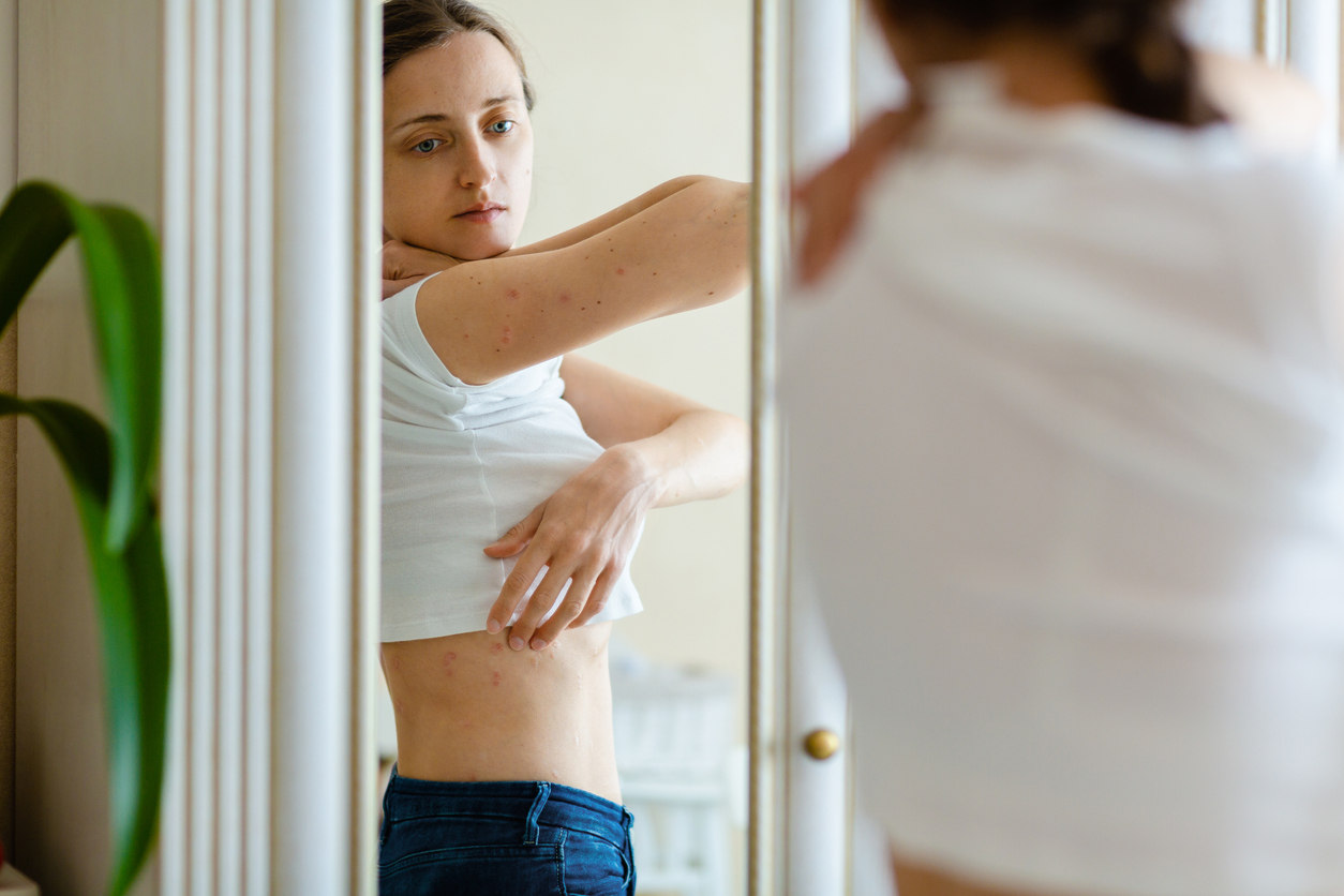 A Young Woman In A White T-shirt Examines Psoriasis Patches On Her Side In A Mirror