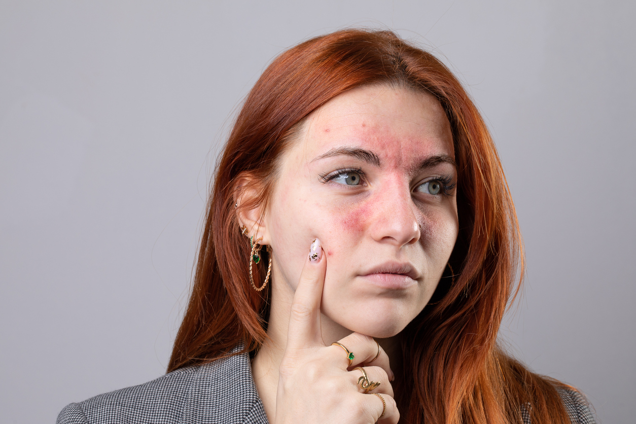 A red-headed young woman with rosacea looks off camera and ponders