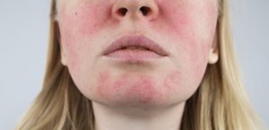 A young, blonde woman tilts her chin upward to display splotchy patches of rosacea redness