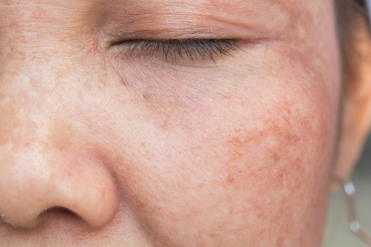 A close up of a woman’s cheek, spotted with sun damage, brown spots, fine lines, & wrinkles