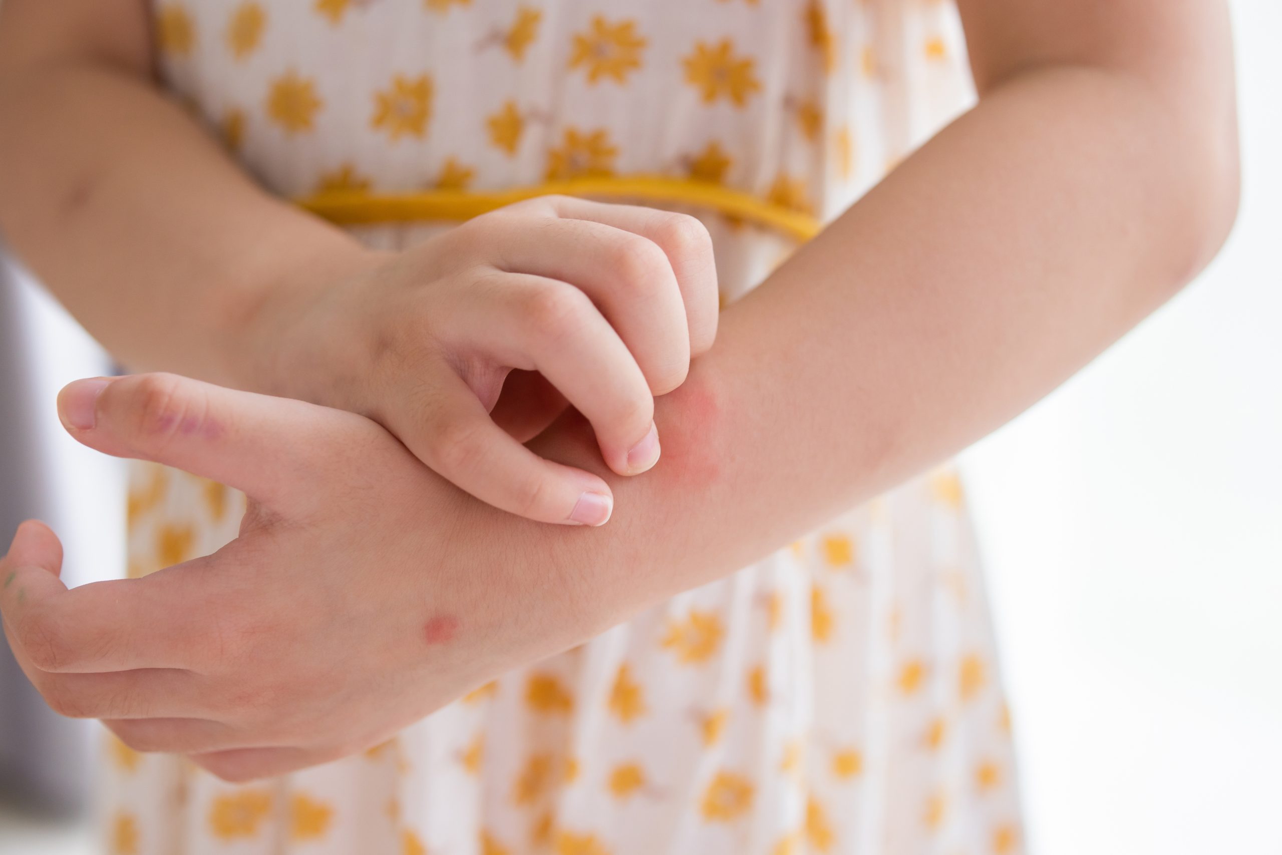 Itchy or painful rashes can be very worrying! Learn when to treat rashes at home and these 5 signs it’s time to visit a dermatologist for rash relief.