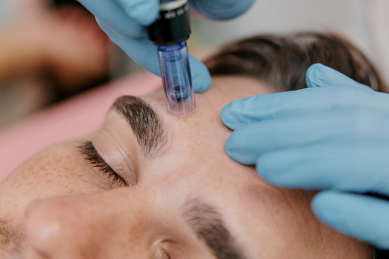 A closeup of a patient receiving a microneedling treatment from a doctor wearing blue gloves at Rodgers Dermatology.