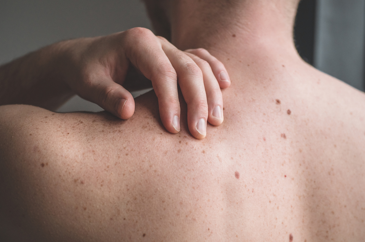 A photo of a man’s upper back, covered in moles and freckles. His hand touches the top of his shoulder as he prepares to do a skin self-exam.