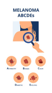 Melanoma ABCDEs symptoms like big diameter, asymmetry, uneven color, uneven border and evolving next to hand of doctor detecting skin cancer spot on back of patient