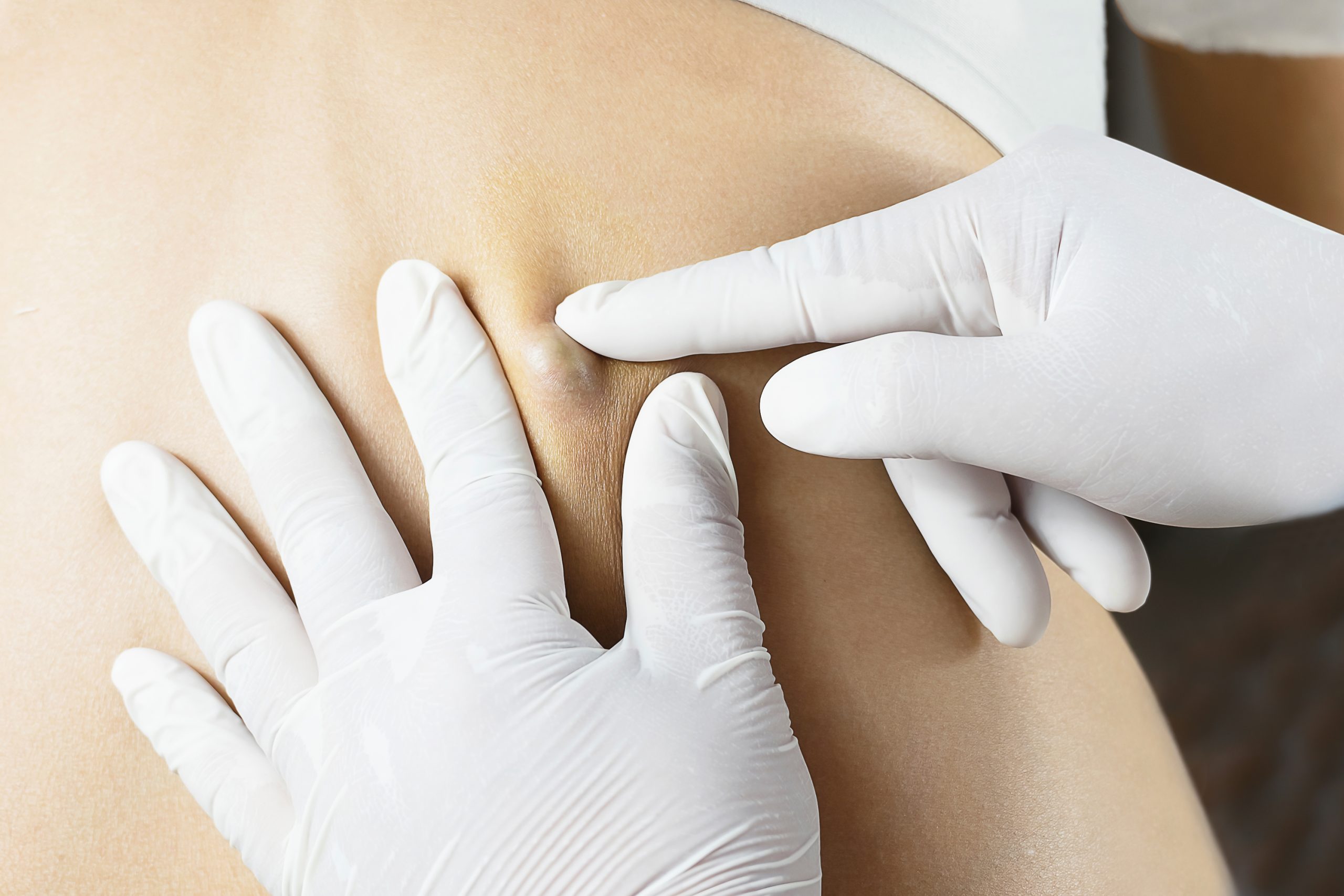 A doctor in white rubber gloves examining a skin cyst on a woman's back.